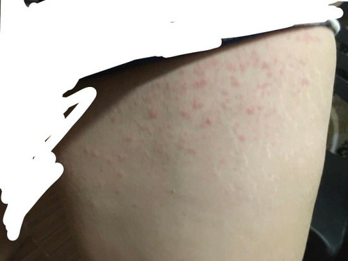 rashes