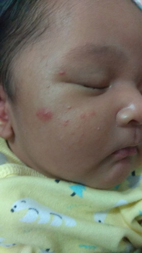 Bercak merah dan digigit nyamuk