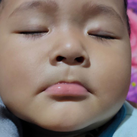 Belnjolan pada kelopak mata