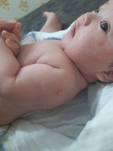bé nhà mình tiêm mũi lao được 2 tháng thì bị sưng mủ lên như thế này là bị sao vậy ạ ?