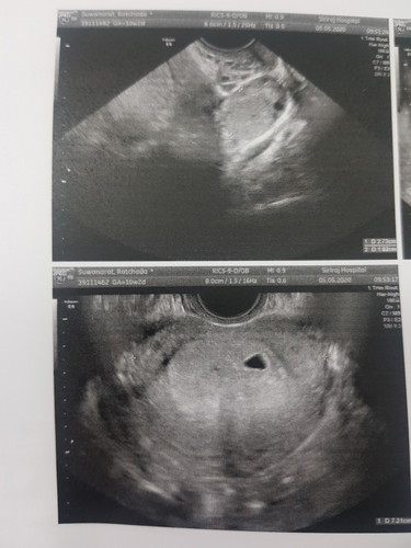 แท้งแล้ว