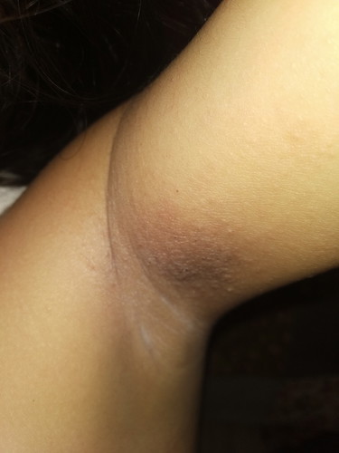 Rashes