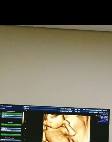 Selisih Usia kehamilan dari USG  & TAP