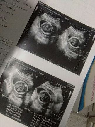 อยากรู้เพศลูก