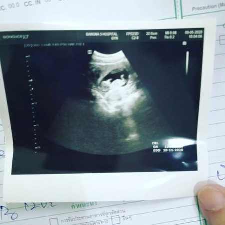 สอบถามหน่อยคับ แฟนผมมีภาวะ แท้ง คุกคาม