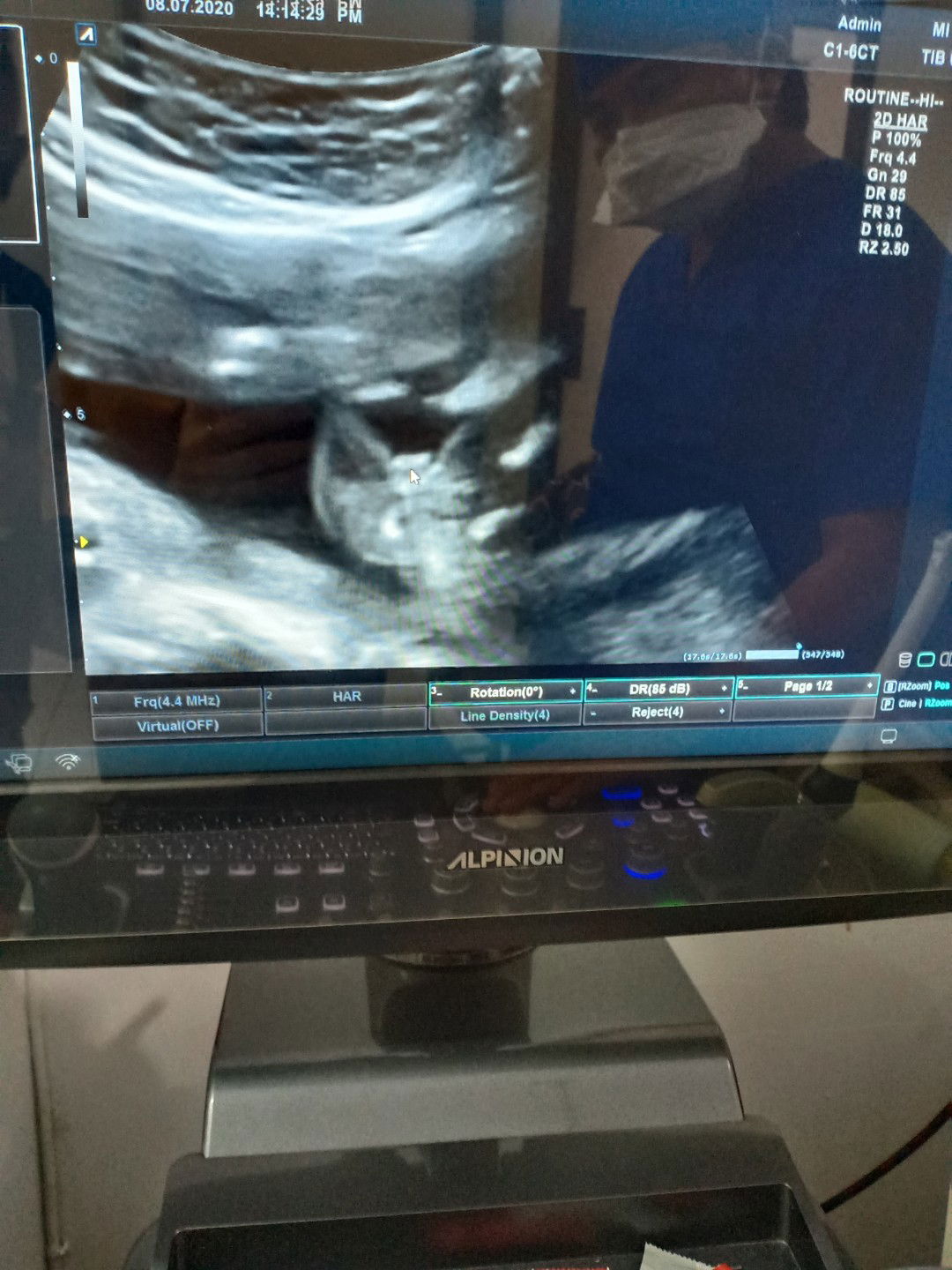 HASIL USG jenis kelamin 18_week