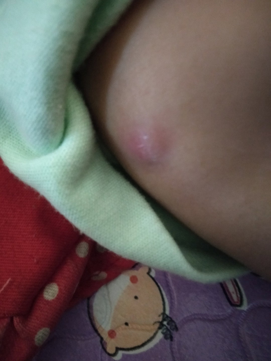 Bentol di lengan atas bayi