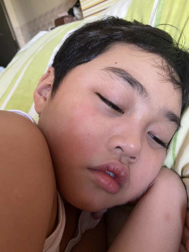 Hi mga sis! ask ko lang if sino may anak dito na may rhinitis?  nilabasan din po ng ganitong raches ung mga anak nyo sa face?