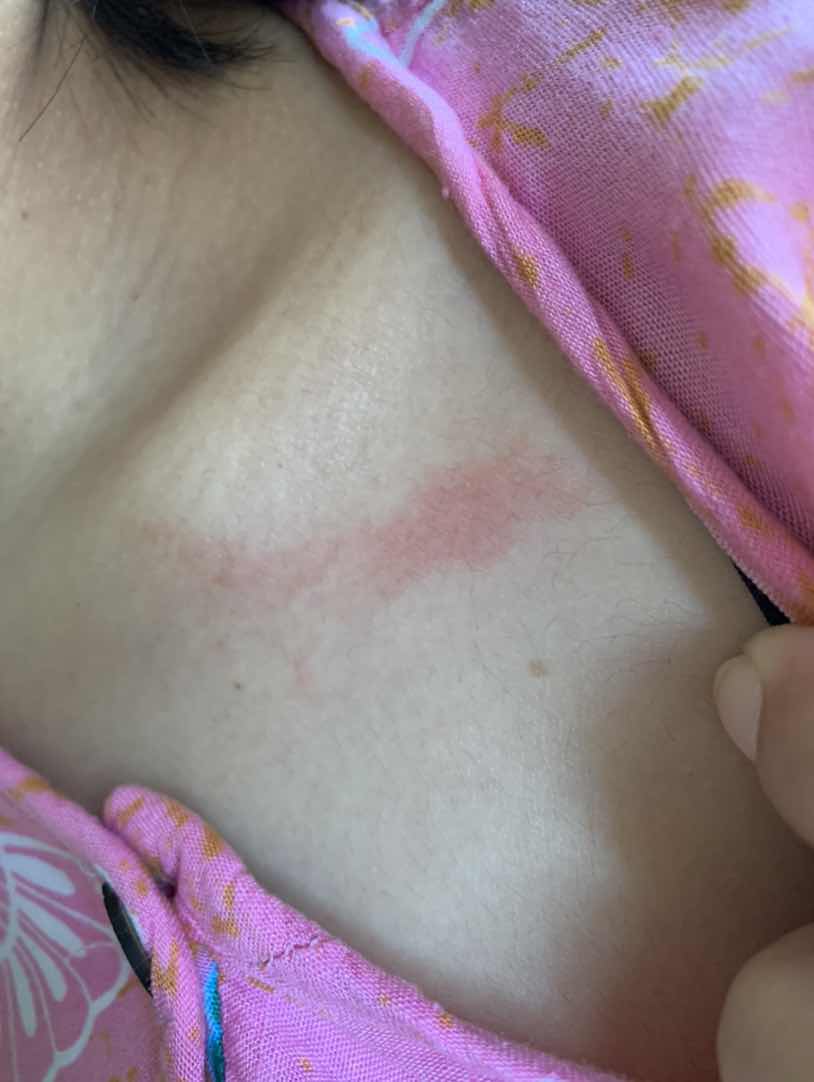 gatal-gatal pada wajah dan anggota tubuh lain