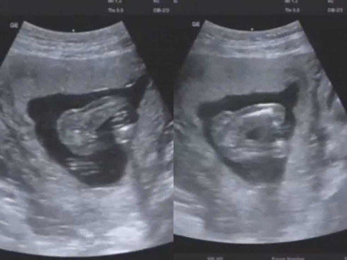 แม่ๆทราบเพศลูกกันตอนกี่วีคคะ