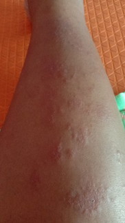 มีแม่ทานไหนมีอาการแพ้แบบนี้บ้าง