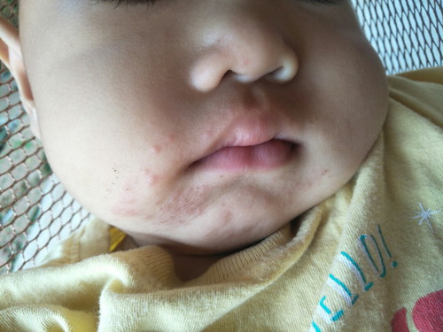 น้องมีผื่นขึ้นตามริมฝีปากเกิดจากอะไรคะ