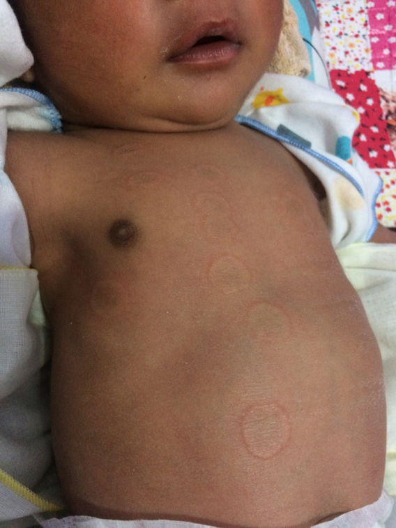 Bruntusan menyerupai koin