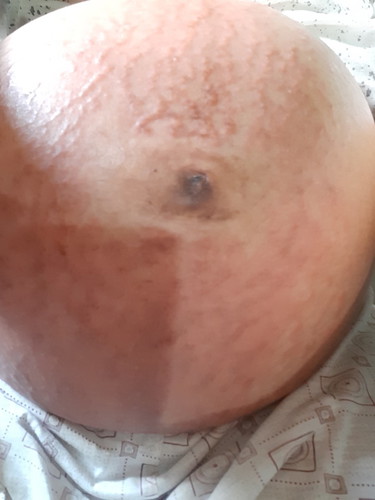 stretch mark
