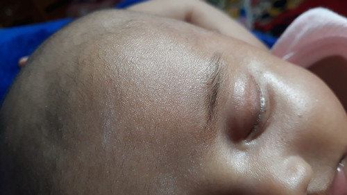 kenapa ya, babyku sudah hampir 2 bulan masih belek an