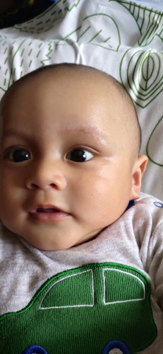 Bintik" pd wajah bayi