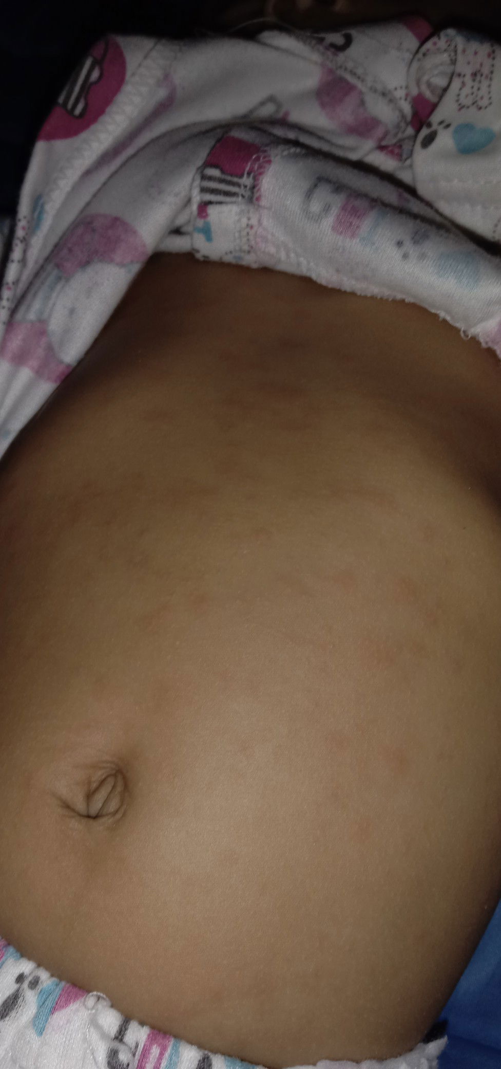 ruam kulit  atau biduran