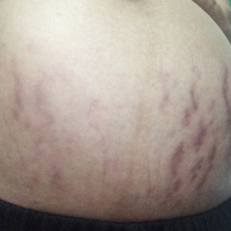 Stretch marks