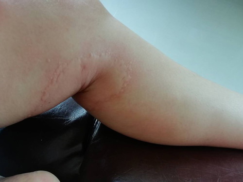 ลมพิษคัน