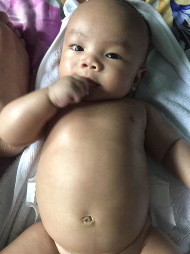 Is it normal for a baby to have a bloated tummy. He's going 4 months this May 4. It really worries me. ?