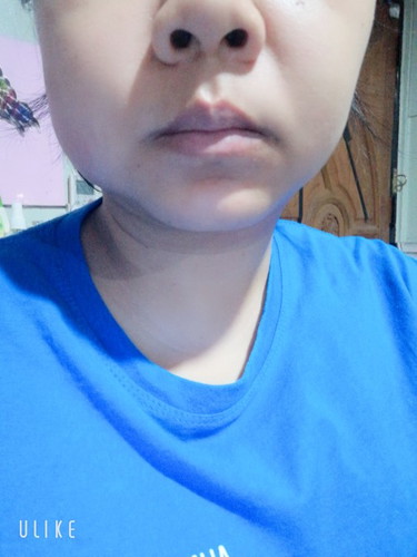 แก้มซ้ายบวม