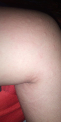 kenapa ya bun semnjak aku diimunisasi hamil T2 badan aku jadi gatel semua seluruh badan padahal hamil pertama saya gk seprti ini