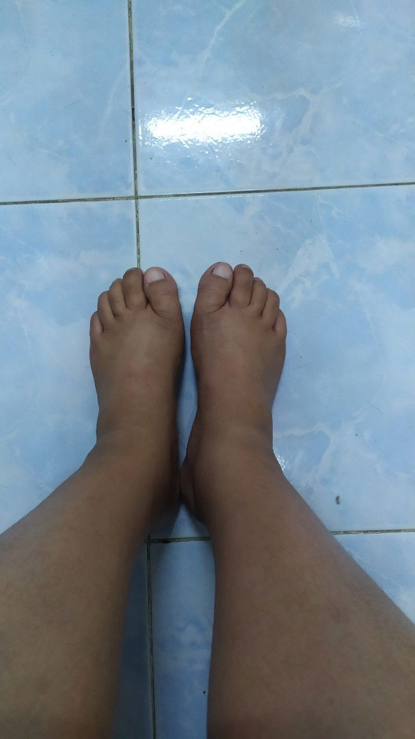 เท้าบวมแล้วตกใจมากก 35W5D