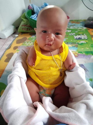 น้องเก้า เด็กน้อย 3 เดือนอารมดี เด็กที่พิการมือ