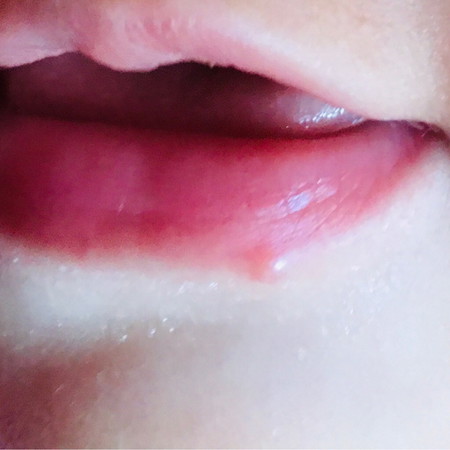 Cold sore / drool rash ? Or pimple