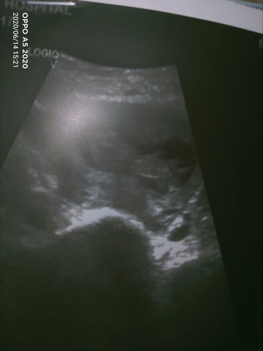 ท้องที่3อยู่ในภาวะแท้งคุกคาม