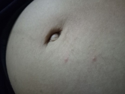 ผื่นขึ้น