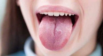 sariawan atau apa ya?