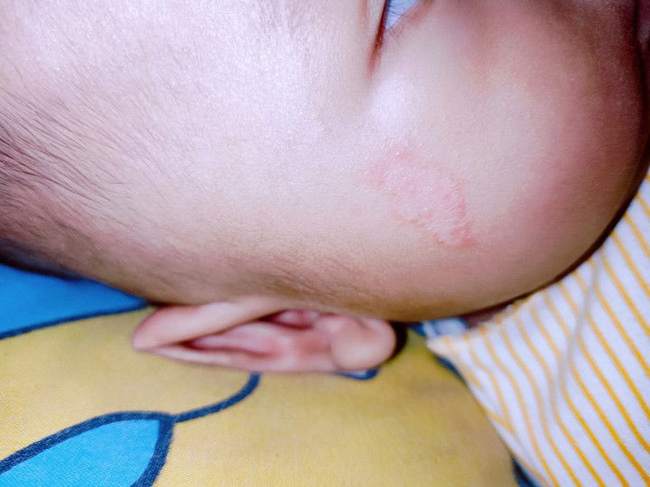 ruam pipi pada bayi 4 bulan