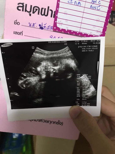 น้ำหนักต่ำกว่าเกณฑ์
