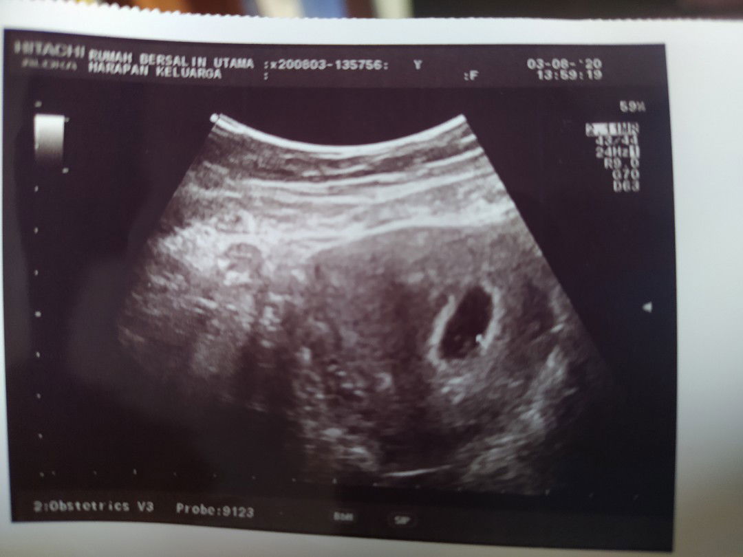 belum terlihat janin da djj