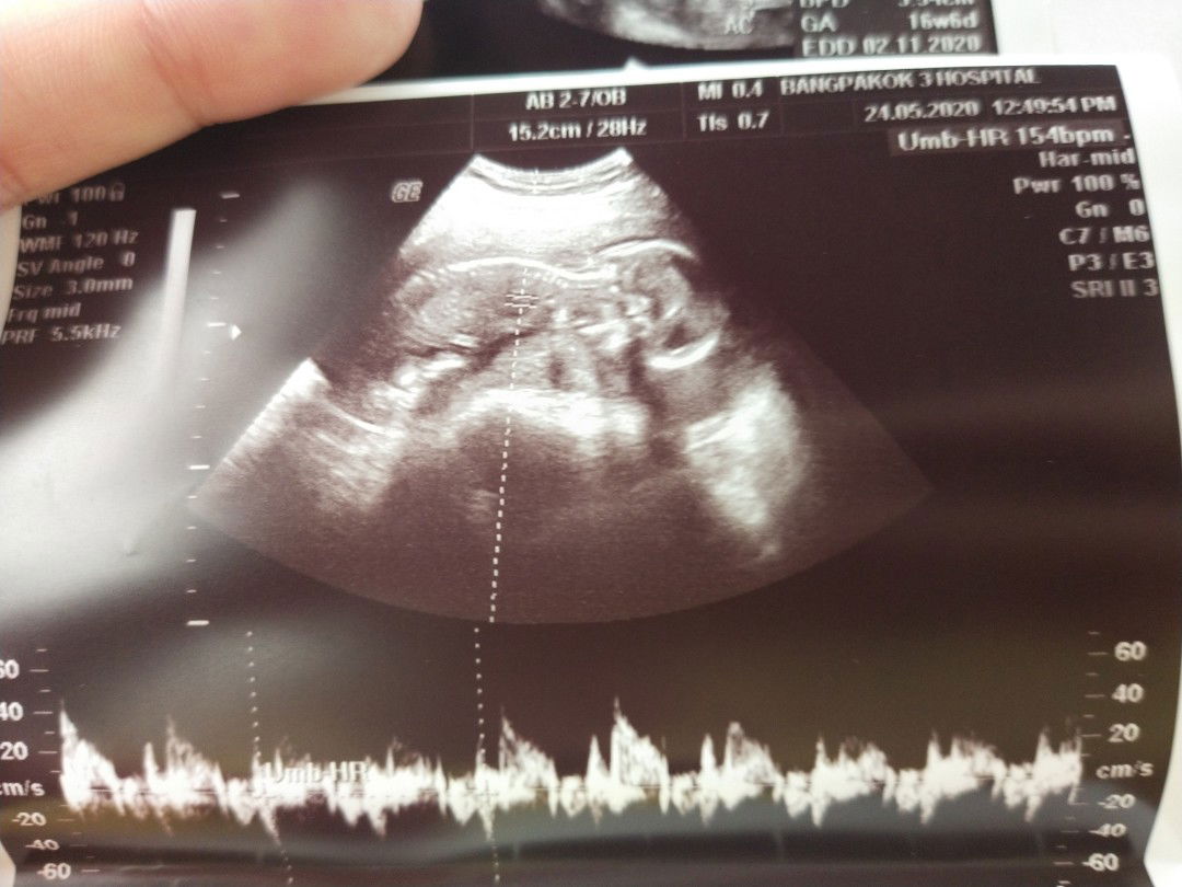 ตอนเห็นลูกในอัตราซาวเป็นครั้งแรกคุณกับแฟนรู้สึกอย่างไร