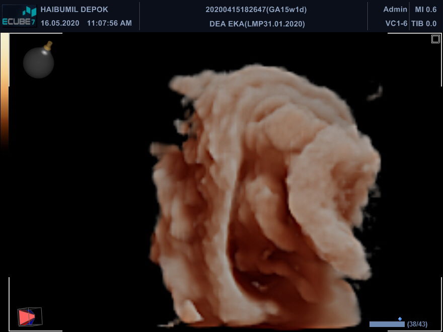 plasenta menekan ke dalam