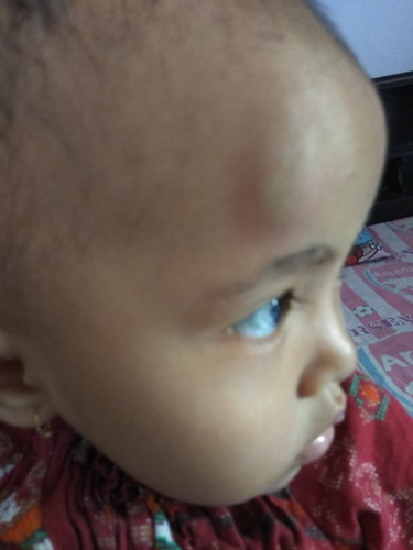 Benjut pada anak