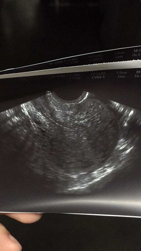 ตั้งครรภ์ 5w แต่ซาวน์ไม่เจอถุงครรภ์