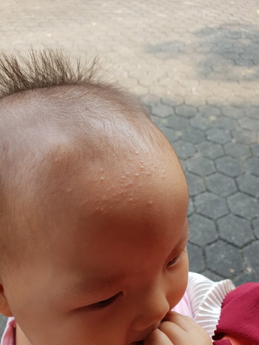Bintik bintik di dahi kepala bayi