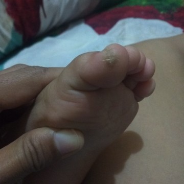 kaki keras belah