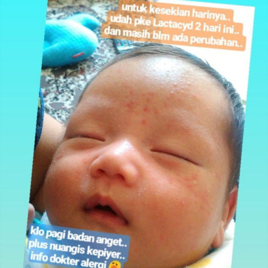 ruam di muka pada bayi baru lahir