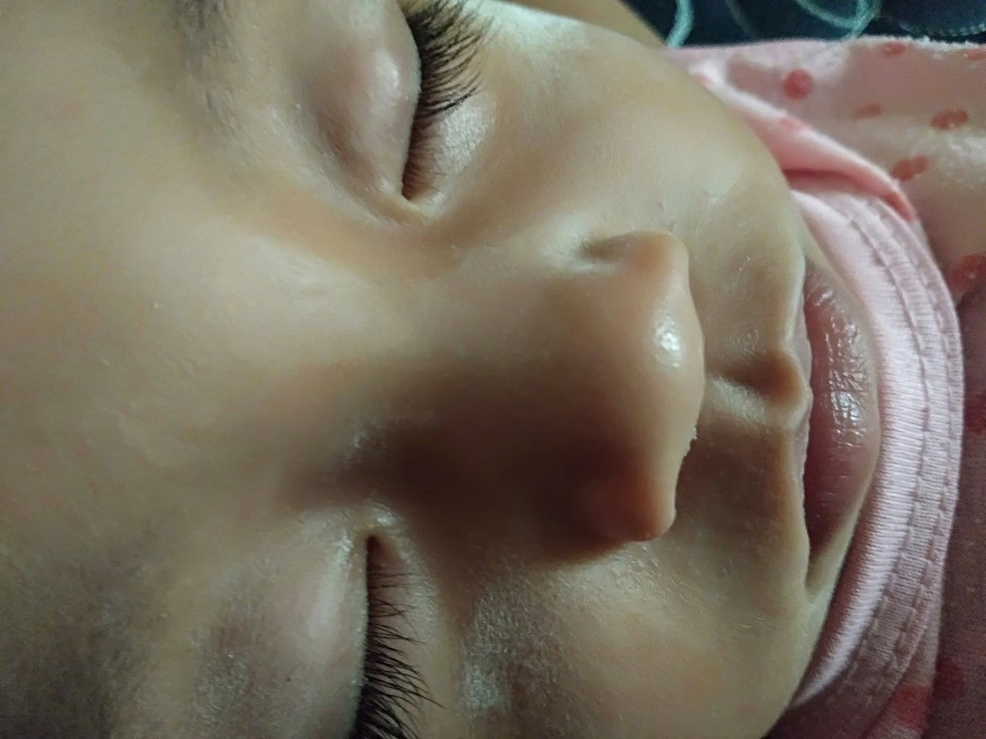 benjol di kelopak mata