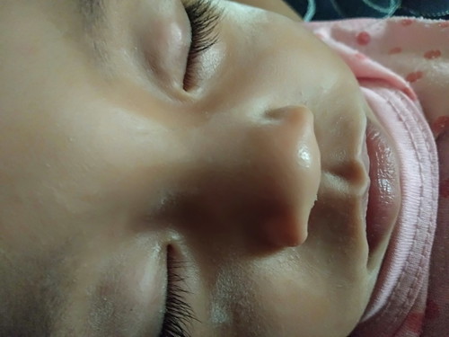 benjol di kelopak mata