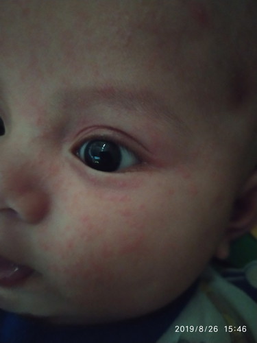 bintik merah di wajah bayi