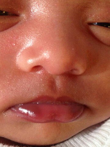 bibir bayi berwarna hitam tidak merata