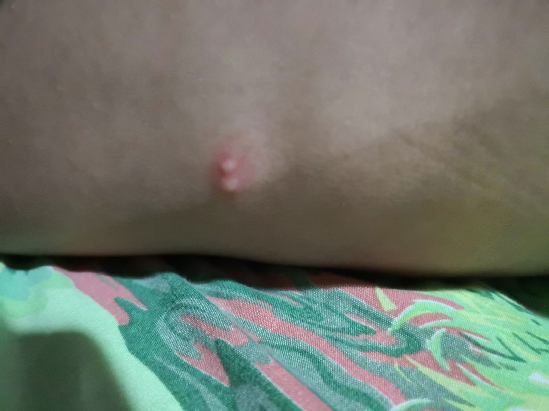 ไม่แน่ใจว่าโดนยุงหรือตัวอะไรกัด