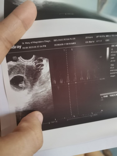 Misdiagnosed! I AM TRULY PREGNANT!