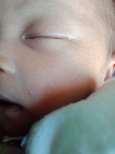 bintik putih di muka bayi