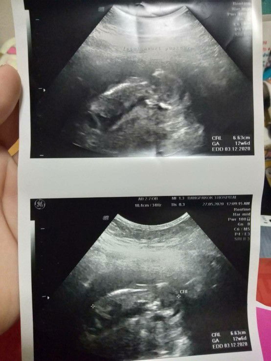 เลือดออกระหว่างตั้งครรภ์